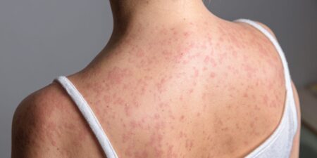 Who Should Worry About Measles Right Now, According to Doctors