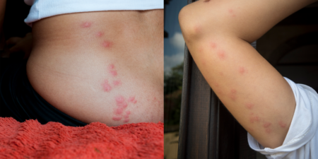 What Bed Bug Bites Look Like, Per Experts