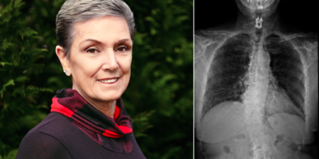 I Lived With Chronic Pain for 10 Years Before My Scoliosis﻿ Diagnosis