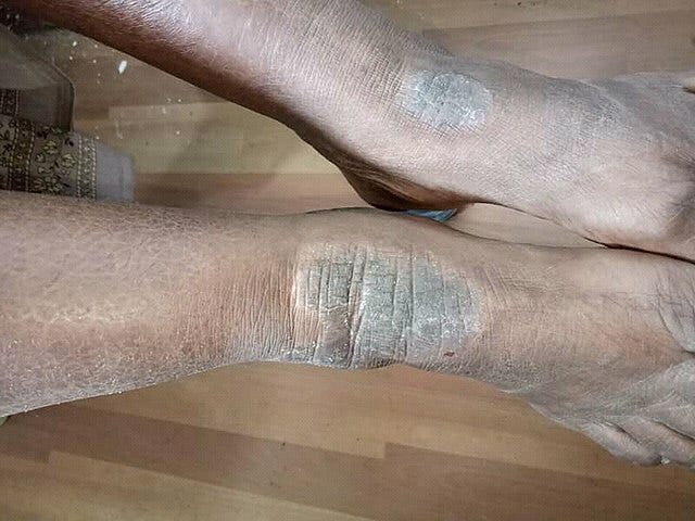 nuerodermitits eczema pictures on black skin