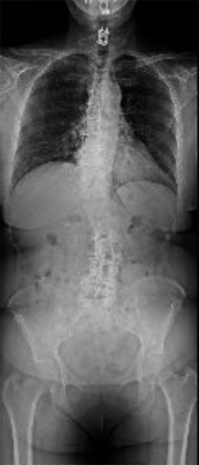 jacquelin lodovico x ray of spine