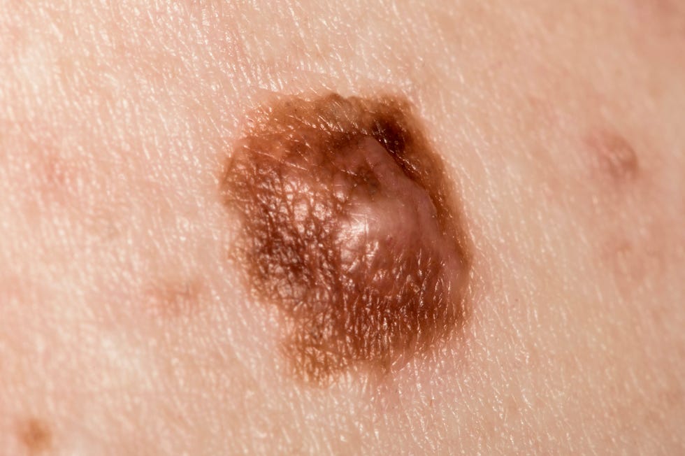 melanoma