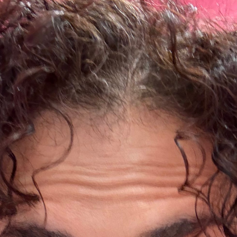 my forehead at 4 months after a huge dose of daxxify