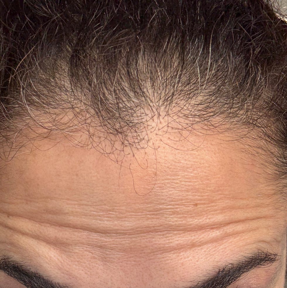 my forehead three months after 50 units of Botox