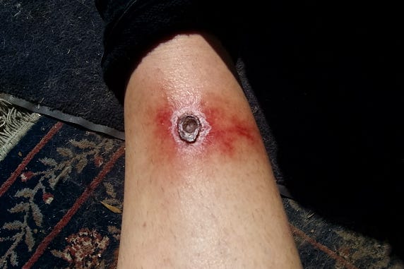 brown recluse spider bite