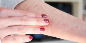 32 Pictures of Common Skin Rashes and How to Identify Their Symptoms