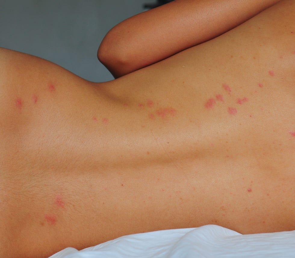 bedbug bites on back lying in bed