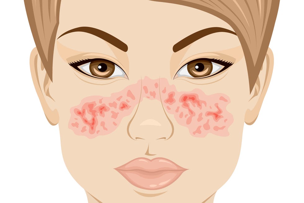 illustration of lupus