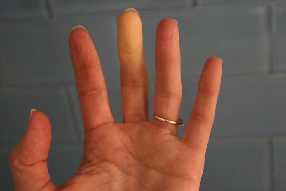raynaud’s syndrome phenomena adult hand