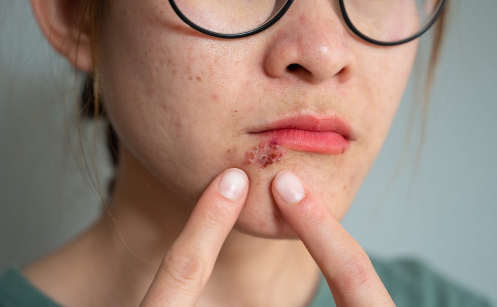 Cold sore