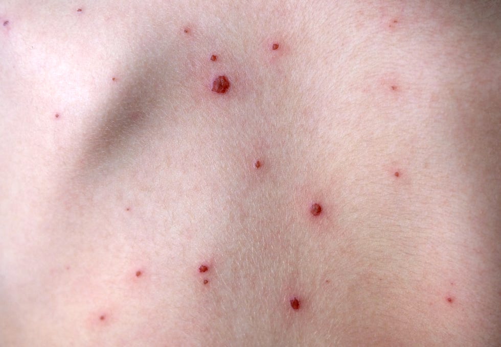 Chickenpox