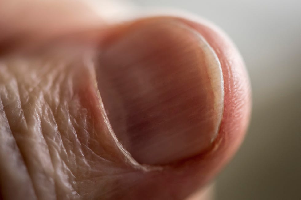 close up of thumb nail with vertical fingernail ridges