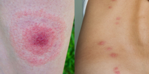 17 Pictures of Common Bug Bites