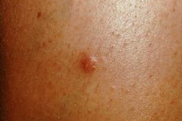 dermatofibroma