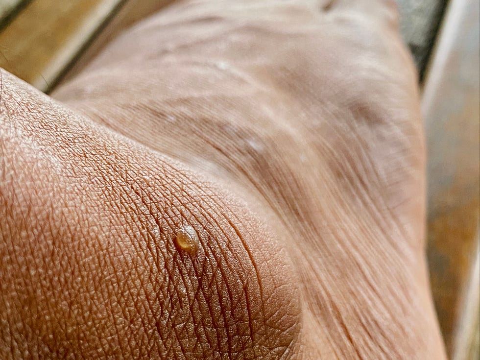 blister