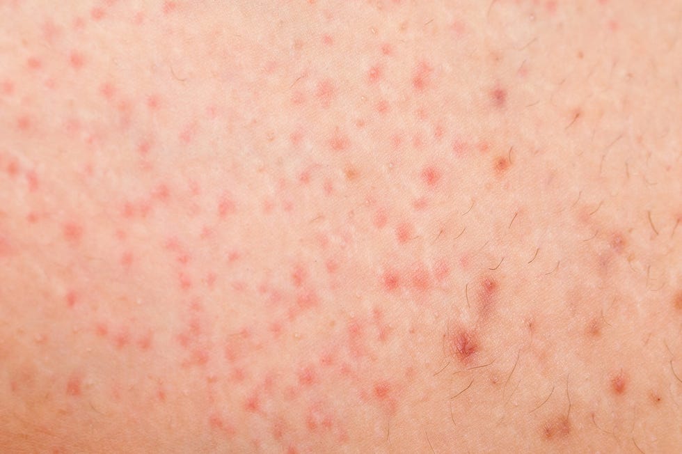 Folliculitis on female skin