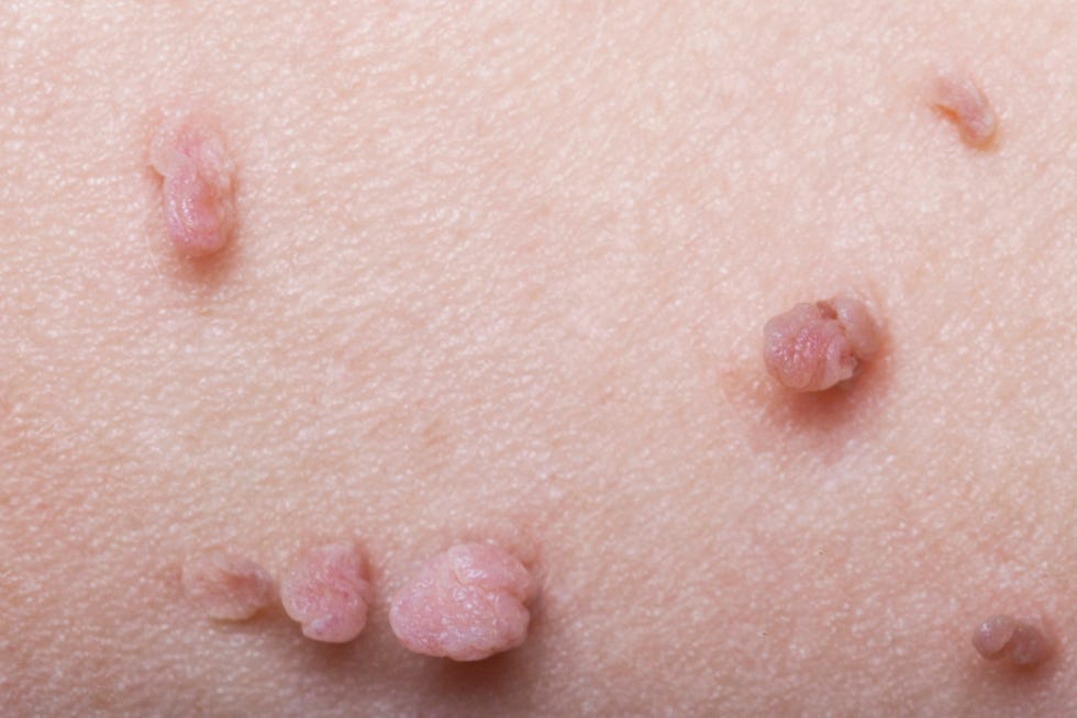 skin tags