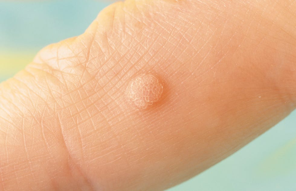 warts