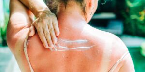 Best Natural Sunburn Cures for Instant Relief, Per Dermatologists