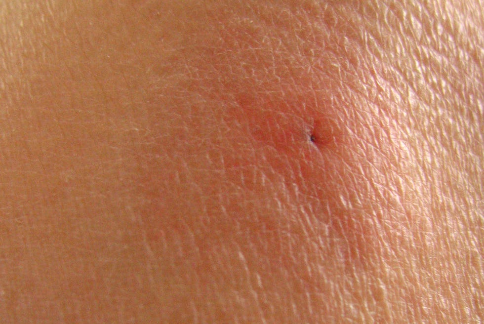 up close image of tick bite right after tick was pulled