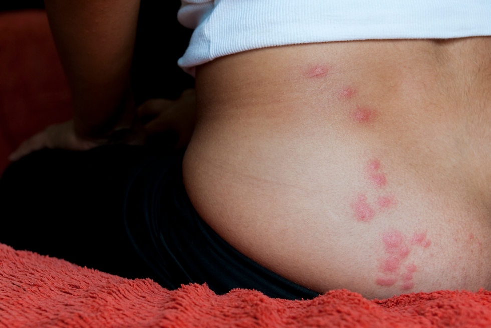 bed bug bite pictures