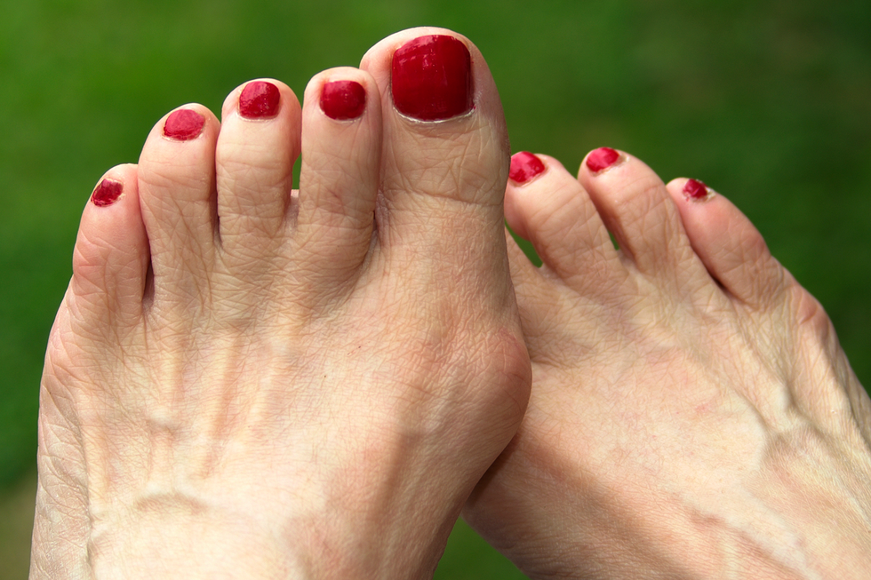 bunions foot pain