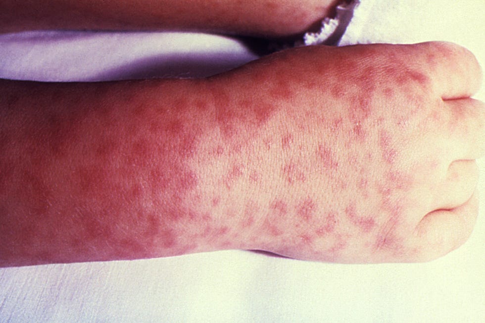 Rocky Mountain spotted fever