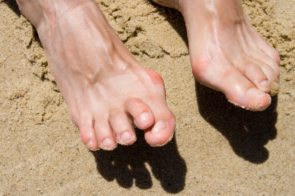 hammertoes