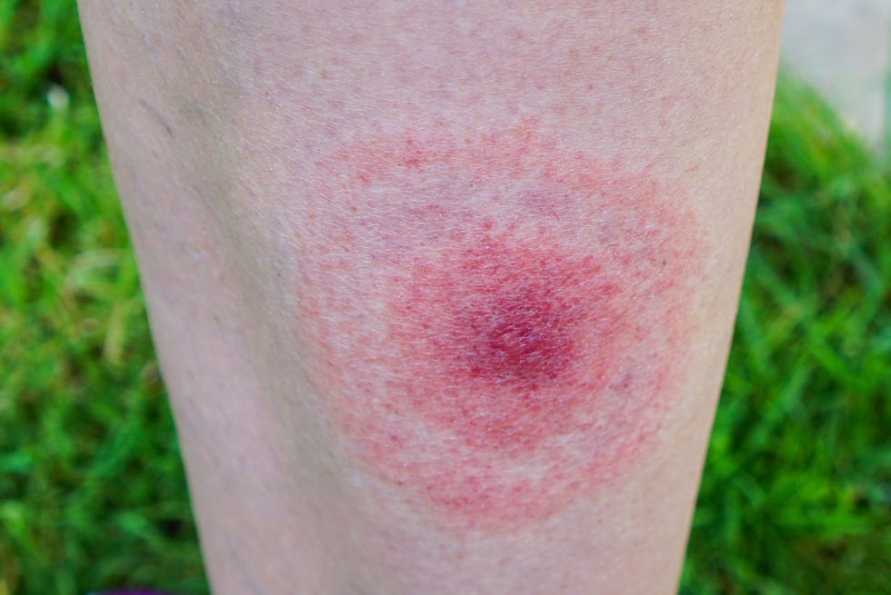 Lyme disease, Borreliosis or Borrelia, typical lyme rash, spot.