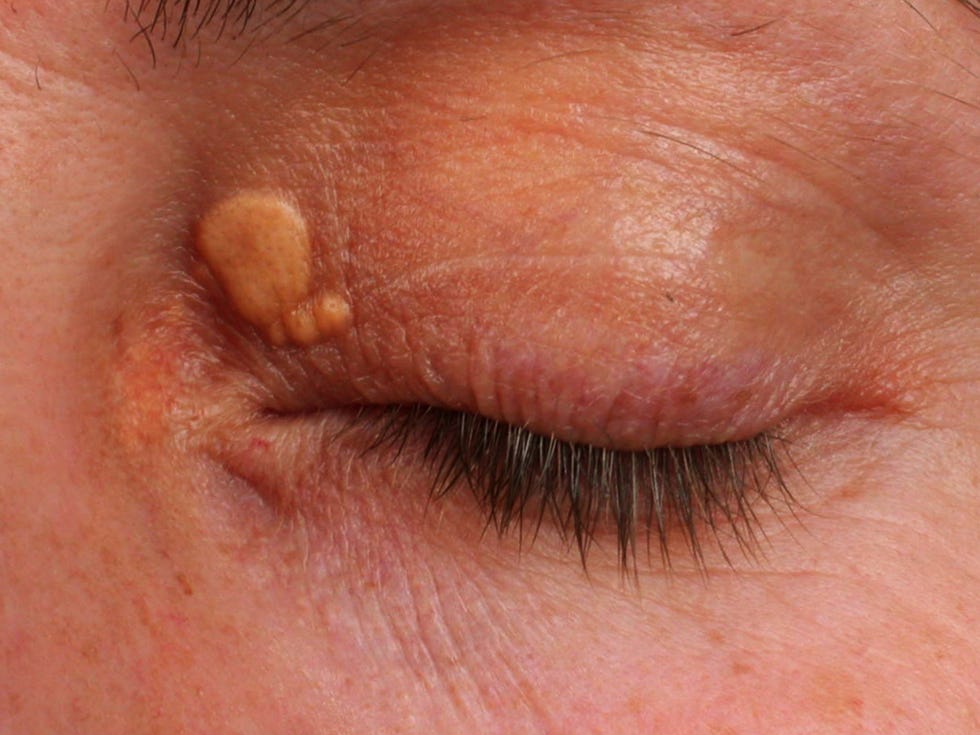 Xanthelasma